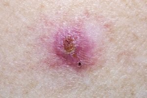 Basal cell carcinoma with an ulcer like appearance