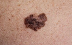 Blotchy melanoma on the skin