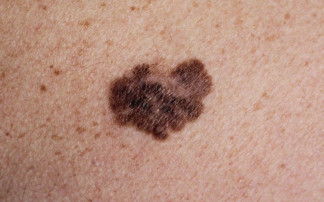 melanoma skin moles