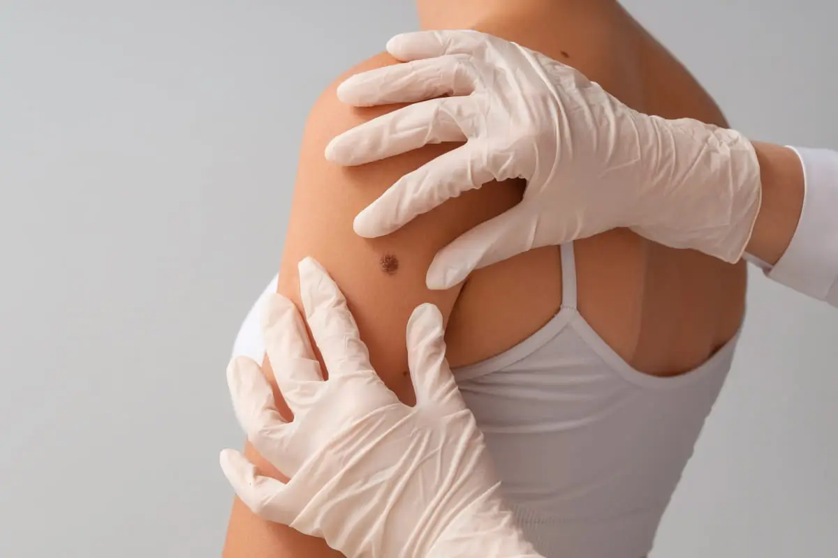 Early Stage Skin Cancer Typically Appear