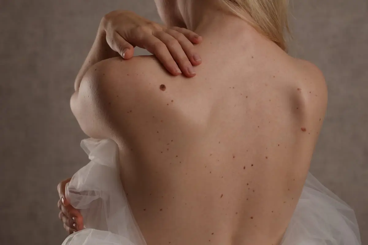 Does mole mapping detect cancer