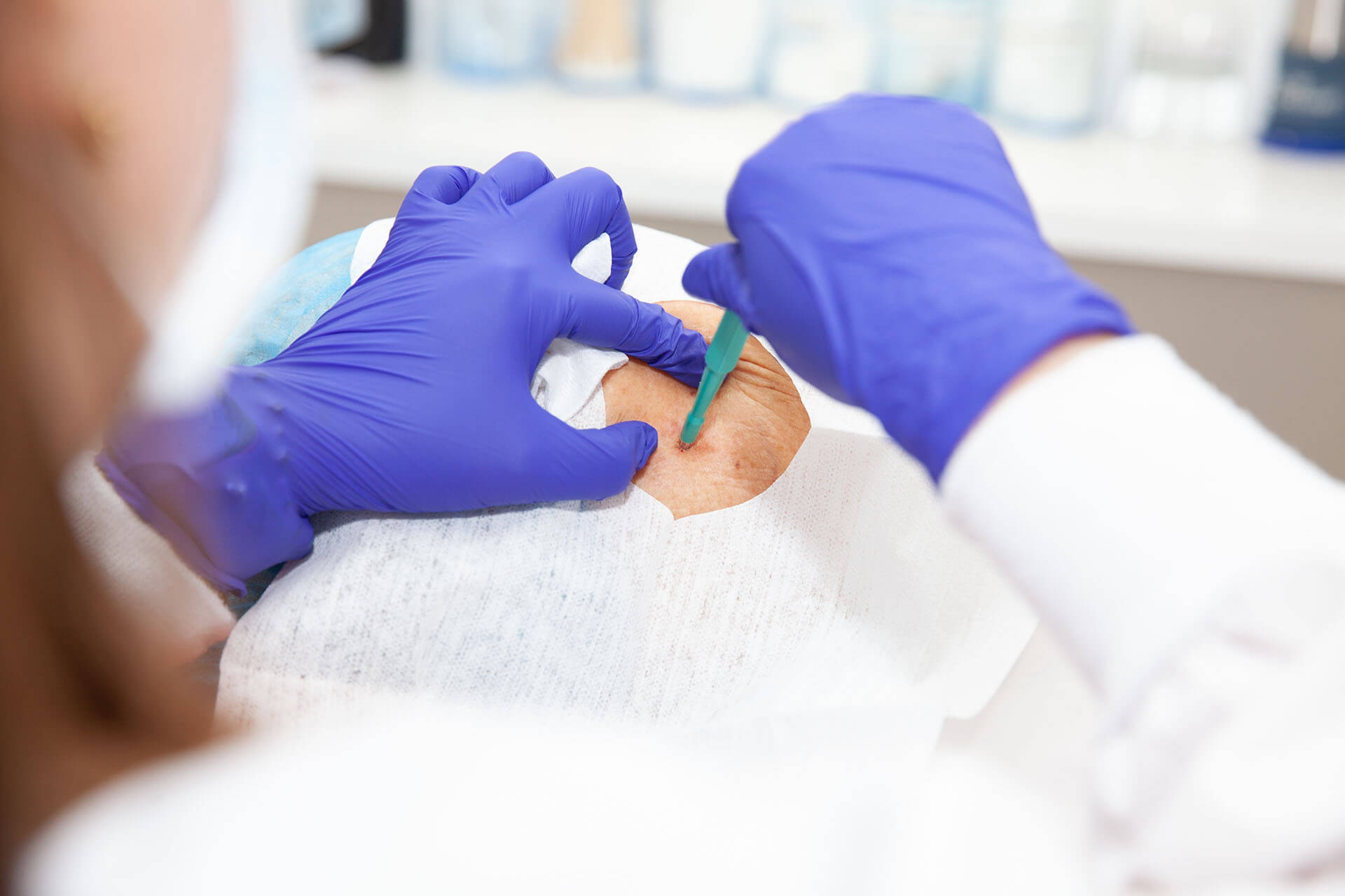 Skin Biopsy in Melbourne