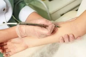 cosmetic mole removal